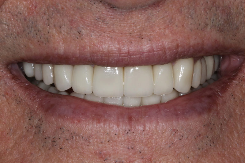 Natural Crowns After