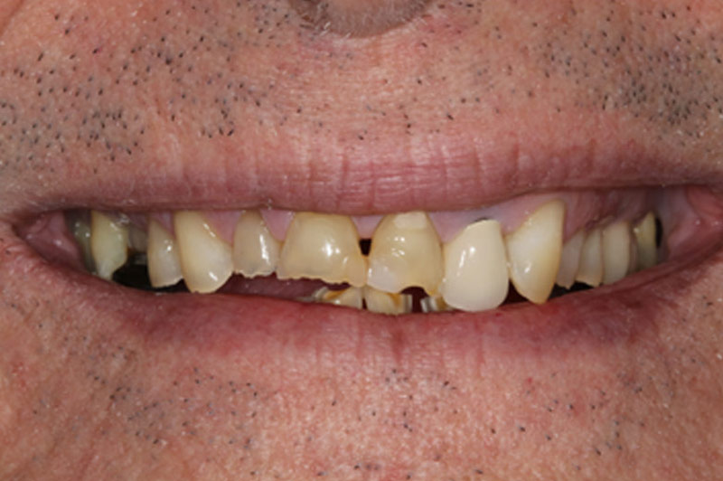 Natural Porcelain Crowns Before