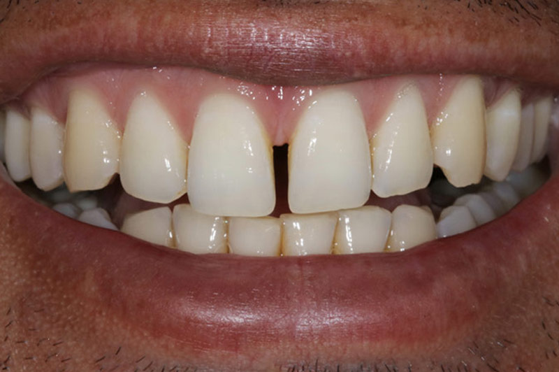 Freehand Bonding B1.2