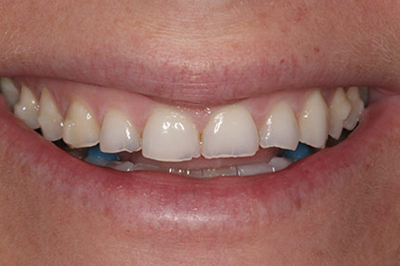 Porcelain Veneers Before 1