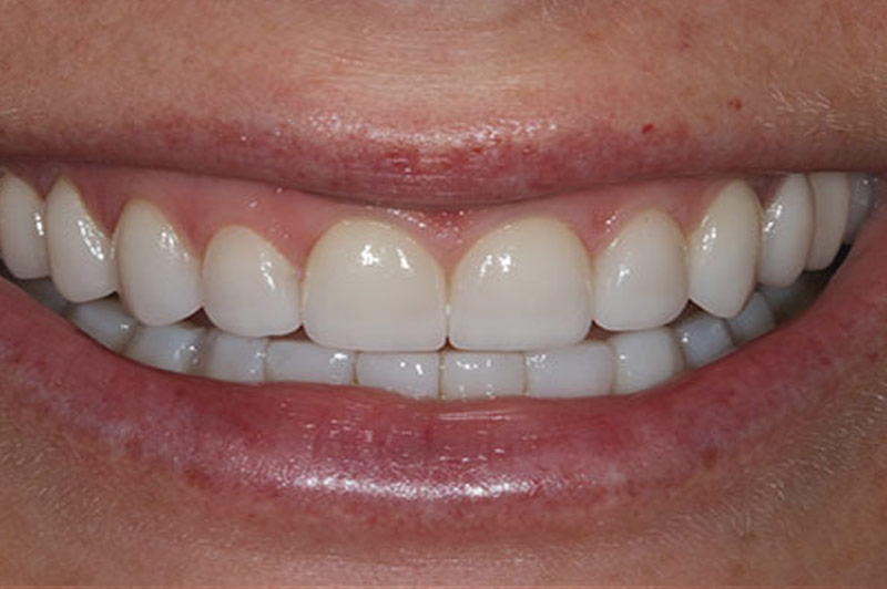 Porcelain Veneers After 1